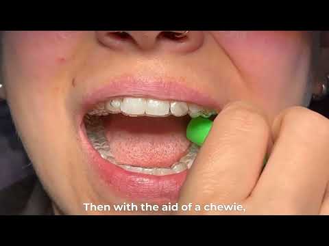 How to use chewies - Dr Naresh Patel