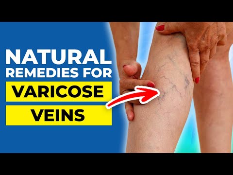 10 Natural Remedies for Varicose Veins