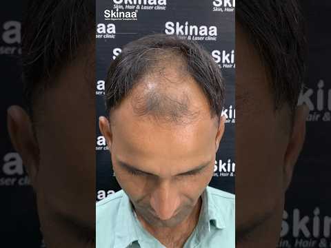 Hair Transplant Another Success Story at Skinaa Clinic in Jaipur  #viralshorts #shorts