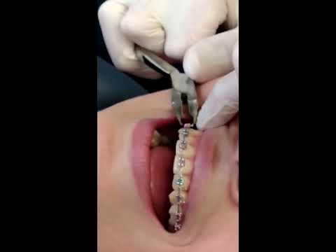 Removing Braces