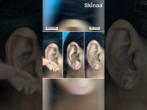 Earlobe Repair Treatment at Skinaa Clinic #viral #shorts