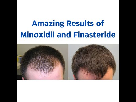 Minoxidil and Finasteride 5% Topical Solution - Before and After Result - One Month Journey