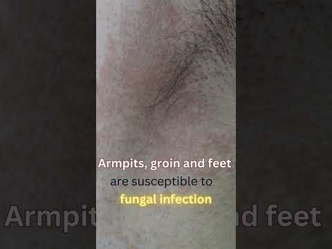 fungal infection I athletes foot I skincare I fungal nail I ring worm