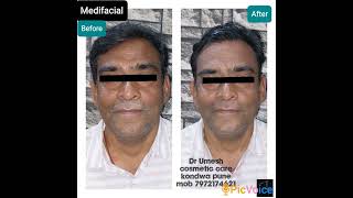 #face #skin #cosmetic #medifacial #detan #detanfacial #detanning #skinwhitening #skincareroutine