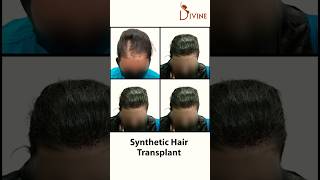 Female Hair Transplant | Synthetic Hair Transplant | Biofiber Hair Transplant in Woman #short