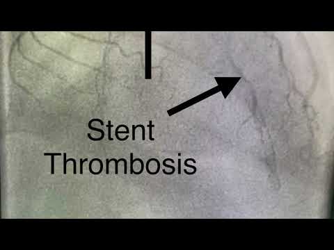 Stent Thrombosis. Importance of not stopping blood thinners after Stenting .