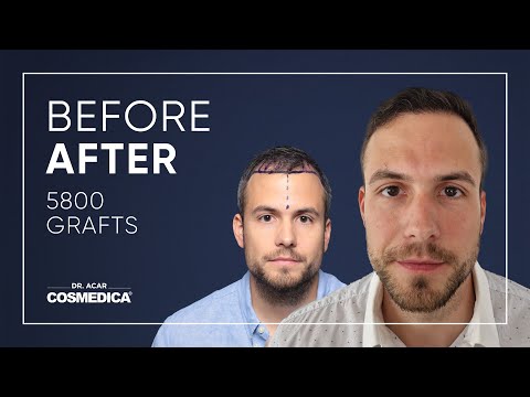 Hair Transplant in Turkey | Results | Dr. Acar | Cosmedica Clinic