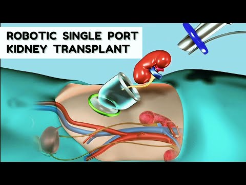 Robotic single port kidney transplant Procedure | Animation