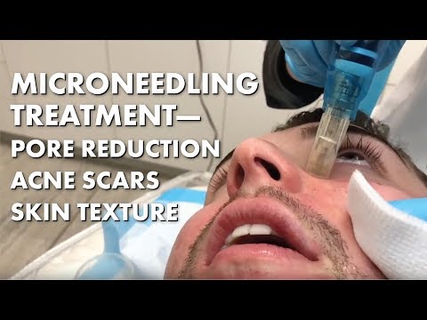 Jackhammering My Face!! Why I decided To Try Microneedling. Minimize Pores + Improve Acne Scars