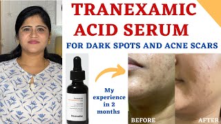 Best serum for dark spots and Acne Scars॥Tranexamic Acid for Hyperpigmentation ✨