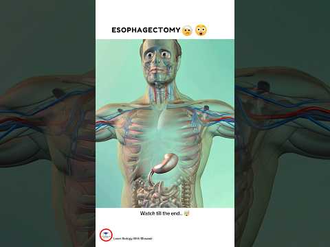 A surgical procedure to remove all of the Esophagus 😳. ESOPHAGECTOMY