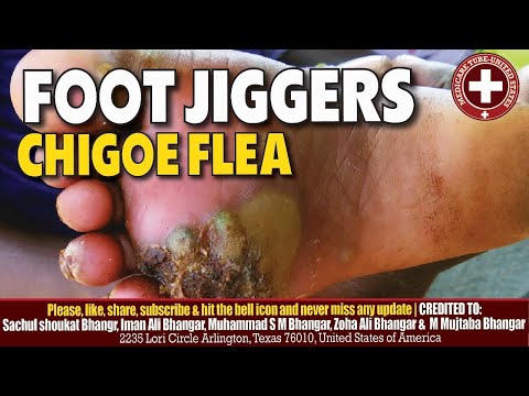 How to Safely Remove Jiggers from Foot | Step-by-Step Guide