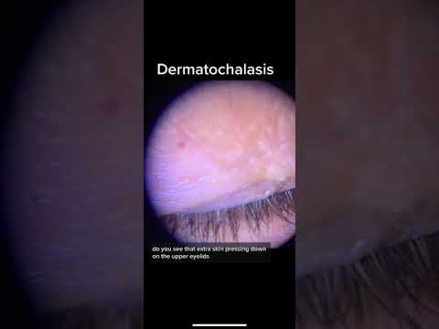 Dermatochalasis  “Baggy Eye Lids”