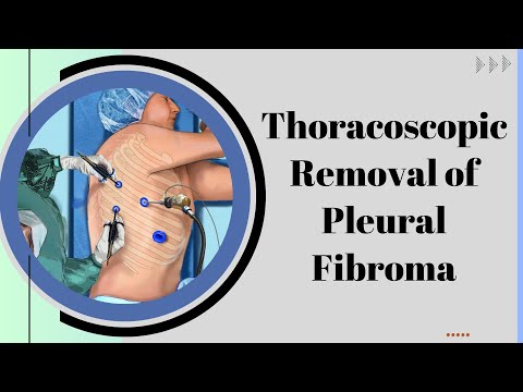 Thoracoscopic Removal of Pleural Fibroma: A Minimally Invasive Approach