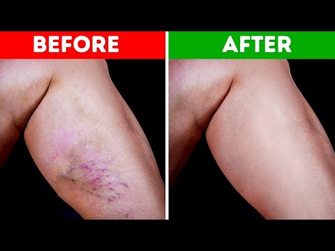 9 Natural Ways to Get Rid of Varicose Veins and Increase Blood Flow