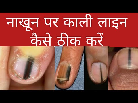 नाखून पर काली लाइन कैसे ठीक करें l black lines on nails