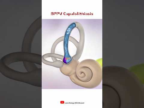 BPPV Cupulolithiasis | #shorts