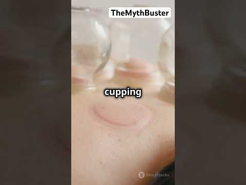 Why Are These Weird Cups on His Back? 🤔 #cuppingtherapy #cuppingmassagetherapy