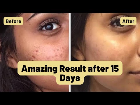 How to get clear glowing skin|Apply this 👆🏼Gel for 7 days and see what happens|