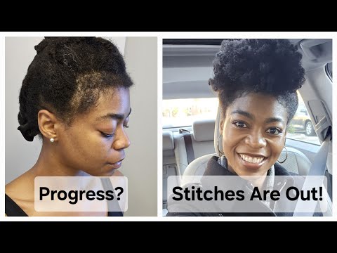 Stitches Are Out! - Hair Loss Update & Progress Photos - 4C Hair/Type 4 Natural Hair