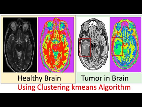 K Means Clustering Algorithm | K Means Brain Tumor Example in R | Machine Learning Algorithms