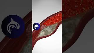 See what a Heart Attack looks like in your body - 3D Animation #heart #heartattack #hearthealth