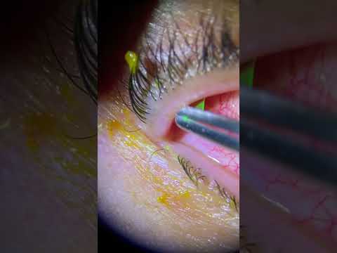 Removal of  A Torn Contact Lens From The Eye.  Has this ever happened to you?