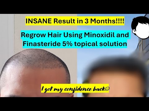 3-Month Hair Regrowth Transformation with Minoxidil & Finasteride 5% Solution Results Before & After