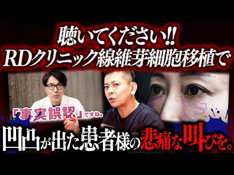 【再生美容医療終了】RDクリニックの再生医療による目の下凹凸の患者様をシンシアが修正。凹凸になった理由を立位3DCTで完全解説します。【北條先生】