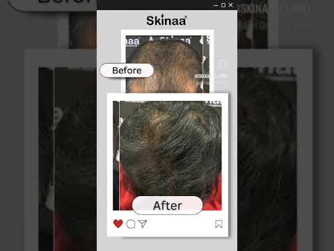 PRP Hair Treatment | PRP Hair Loss Treatment | Skinaa’s Triple Technique #viral #shortsviral