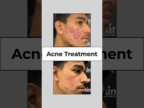 Now Get Rid of Acne with Black Peel Treatment at Skinaa Clinic!  #shorts #viralvideo