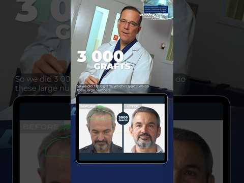 ⚡️Dr. Gartner Unveils Hair Transplant Results / #hairtransplantresults #fuehairrestoration #fuehair