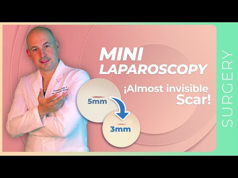 Minimally Invasive Surgery / MINI-Gastric Sleeve