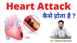 Heart Attack in Hindi, How Heart Attack Happens? Types of Heart Attack in Hindi