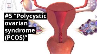11 Punca Punca Istihadah (Abnormal Uterine Bleeding)