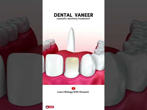 Dental veneer ( Cosmetic dentistry treatment )