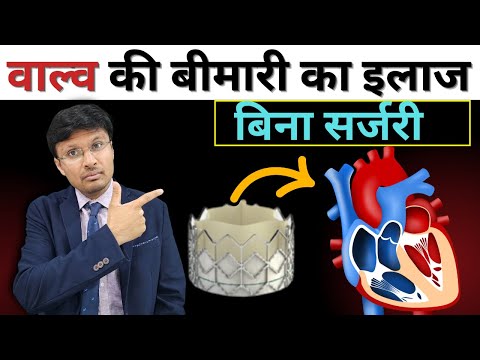 वाल्व की बीमारी का इलाज बिना सर्जरी  Valve Disease TAVI is the Game Changer