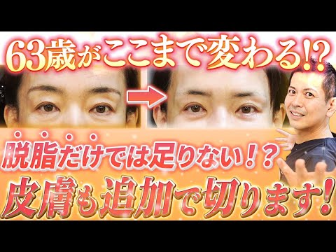 【63歳→36歳!?】脱脂だけでは不十分だった患者様。皮膚を追加で切ったら劇的に若返りました！【クマ取り / 整形】