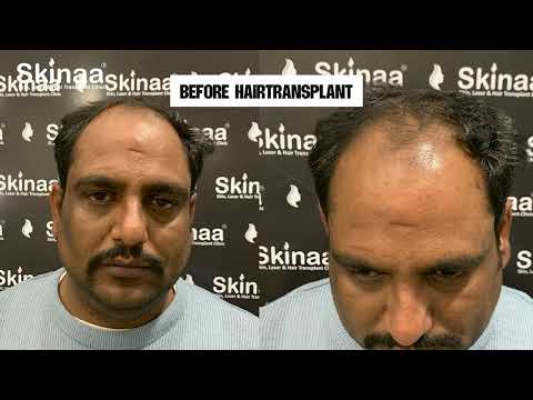 Hair Transplant Results You’ll Love at Skinaa Clinic!