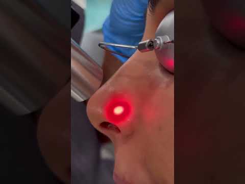 Sound ON 🔉! So satisfying. Photofacial treatment. #toronto #avebelle #torontolife #torontoblogger