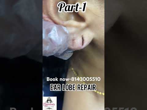 Ear Lobe repair solutionsqueen#booknow