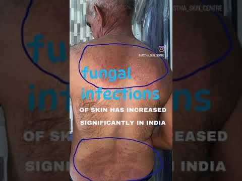 fungal infection I athletes foot I skincare I fungal nail I ring worm