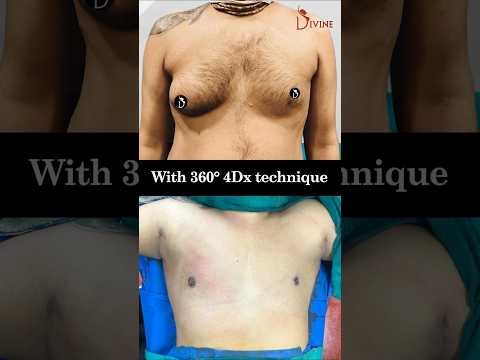 360° 4Dx Transformation: Fixing Asymmetrical Gynecomastia for a Confident Look!