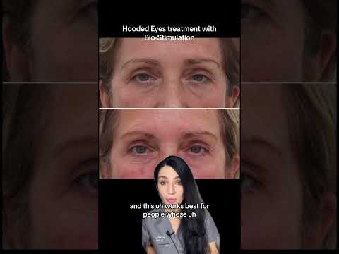 #sculptralift #hoodedeyestreatment #sculptratoronto #avebelle