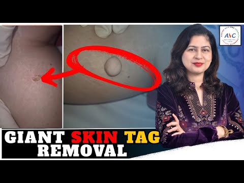 Skin Tag Removal | Safe & Painless Procedure by Dr Cheena Langer | Aastha Skin Centre, Jammu