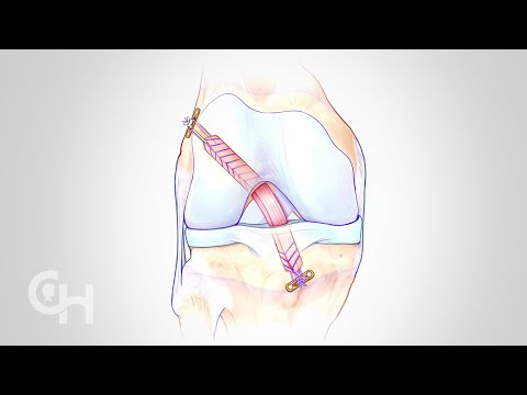 ACL Surgery for Children and Teens: Where You Seek Treatment Matters