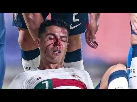 Football Turns Bloody... Players Need to be Safe on the Pitch