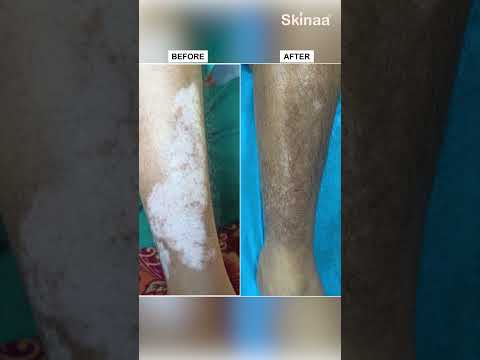 Best Vitiligo Treatments and Amazing Results at Skinaa Clinic #viral #shorts