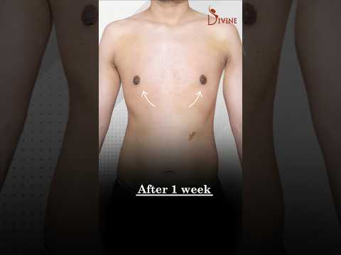 4Dx Gynecomastia Surgery: Sculpted Chest, Instant Confidence | #shortfeed