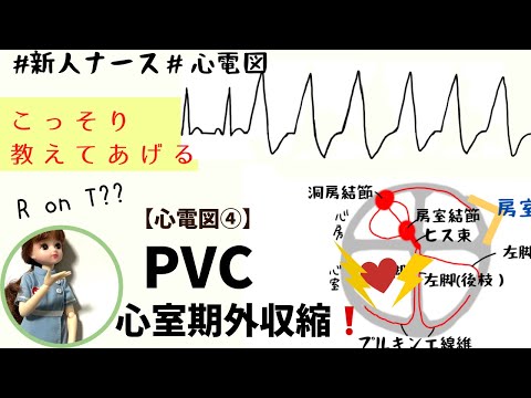 【心電図読み方④】PVC!心室期外収縮ちゃんと学んだほうがいい！#看護師#勉強#新人ナース